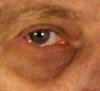 180px-Dark_circles.jpg